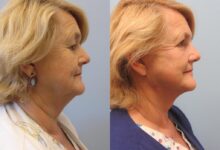 Is a Neck Lift in Dubai the Right Choice for You?