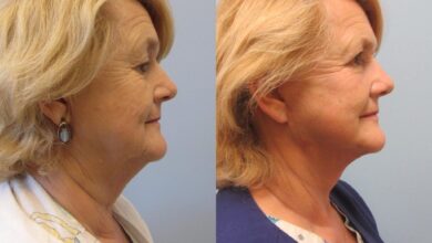 Is a Neck Lift in Dubai the Right Choice for You?