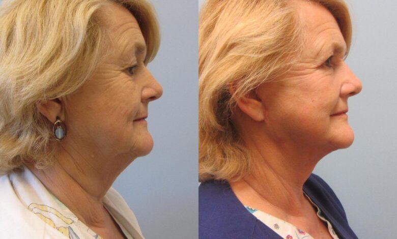 Is a Neck Lift in Dubai the Right Choice for You?